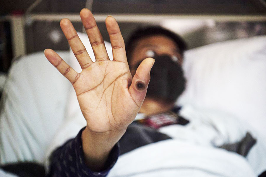 A patient shows his hand with a sore caused by an infection of the monkeypox virus, in the isolation area for monkeypox patients at the Arzobispo Loayza hospital, in Lima on August 16, 2022. Nearly 28,000 cases have been confirmed worldwide in the last three months and the first deaths are starting to be recorded. Image: Ernesto BENAVIDES / AFP

